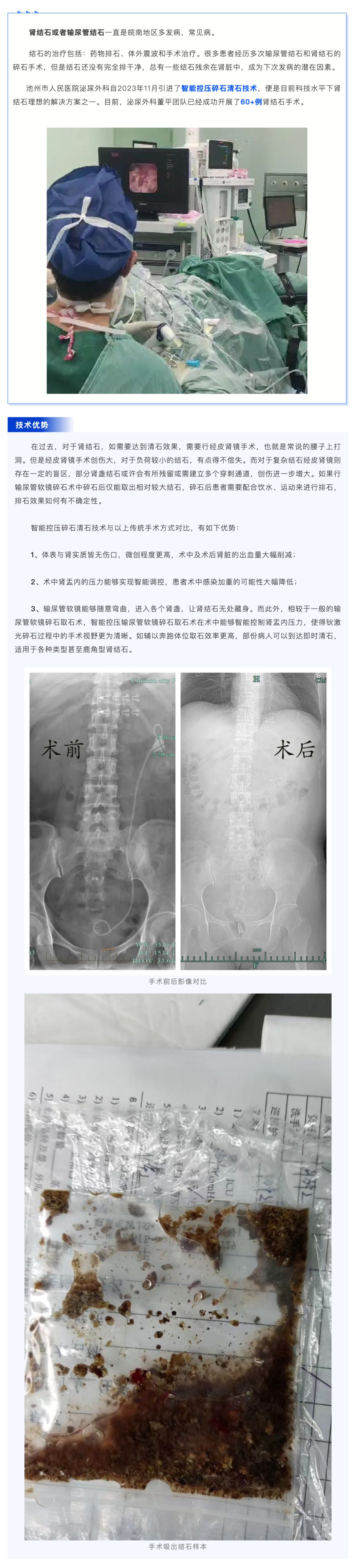 超微創(chuàng)！池州市人民醫(yī)院智能控壓輸尿管軟鏡讓結(jié)石無(wú)處遁形_壹伴長(zhǎng)圖1.jpg